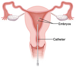 embryo transfer