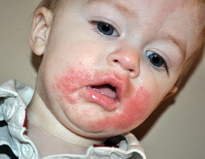 reaksi alergi saus tomat pada anak-anak