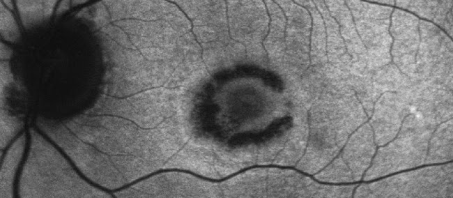 Stromectol 3 mg anwendung