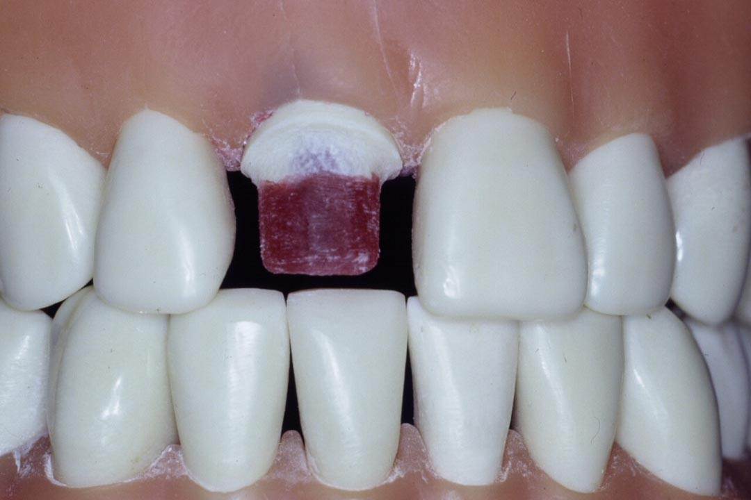 Dentistry Custom Cast Dowel Core