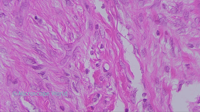 Breast fibroadenoma captured under the microscope at 400x.