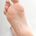 Heel Spur Relief - Plantar Fascitis Cause