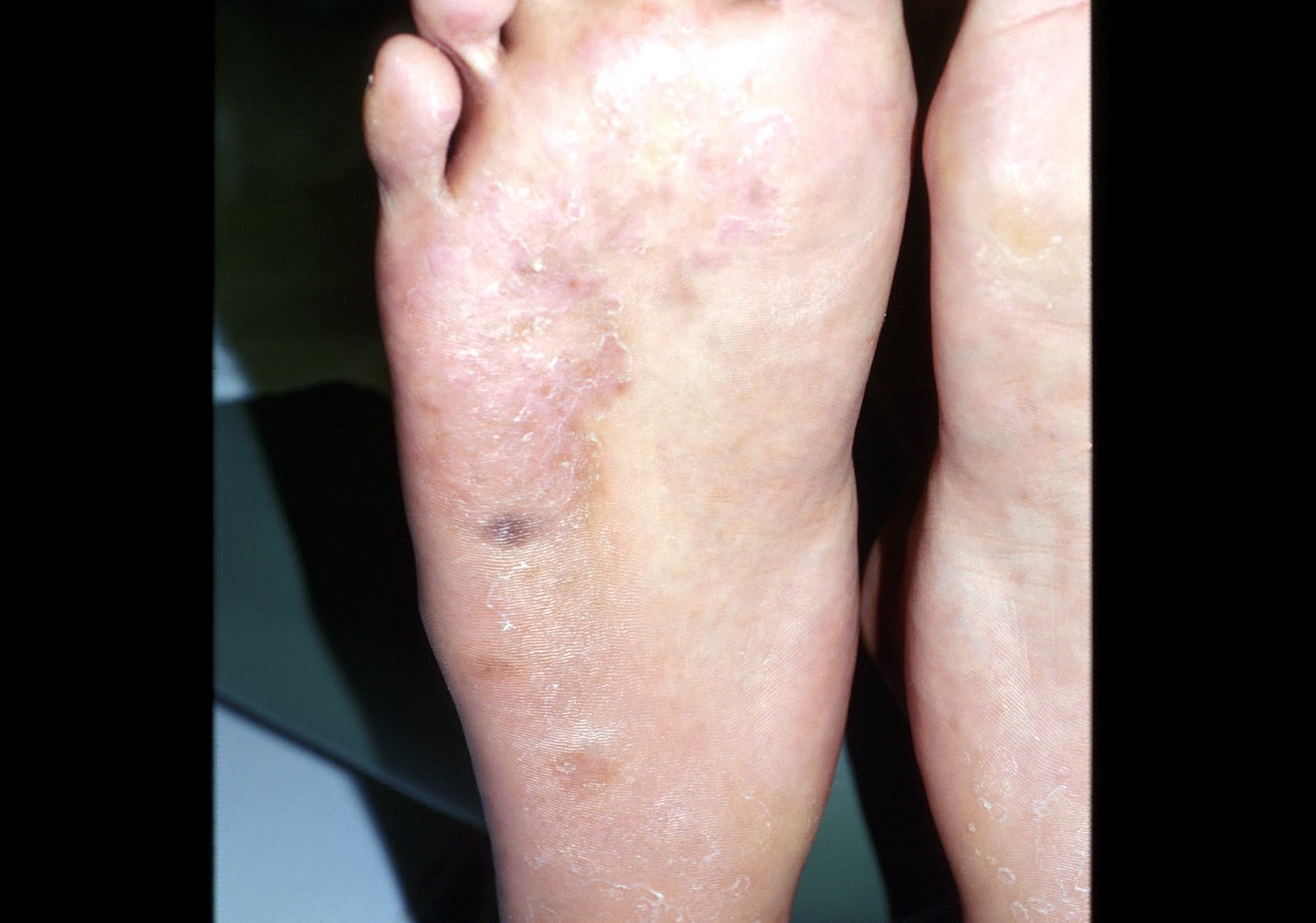 syphilis rashes