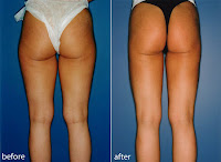 Liposuccion Precios