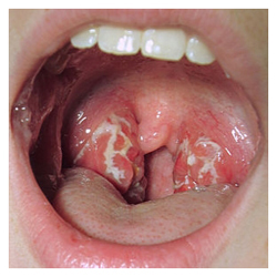 cancer gonorrhea and symptoms health care
