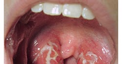 gonorrhea symptoms anus