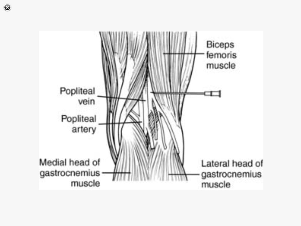 SRNA Daily Review REGIONAL ANESTHESIA BLOCKS