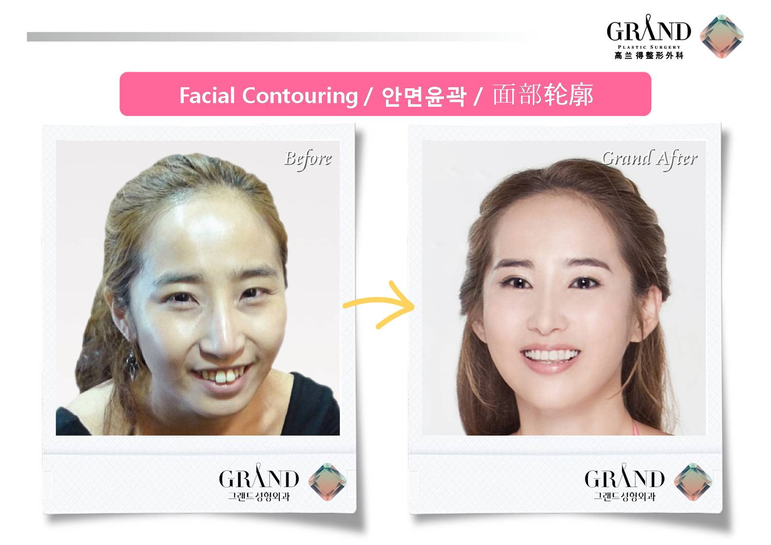 Plastic Surgery Clinic Korea Before & After TWOJAW surgery