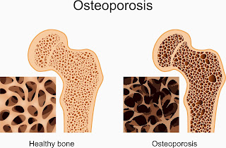 Faktor Penyebab Penyakit Osteoporosis