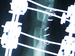 osteogenesis elongacion elongacion