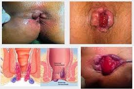 Obat Wasir Faktu Suppository Obat Wasir Faktu Suppository
