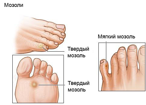 Как избавится от стержневых мозолей в домашних условиях