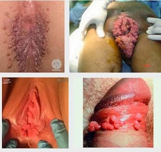 Obat Oles Kondiloma Obat Oles Kondiloma