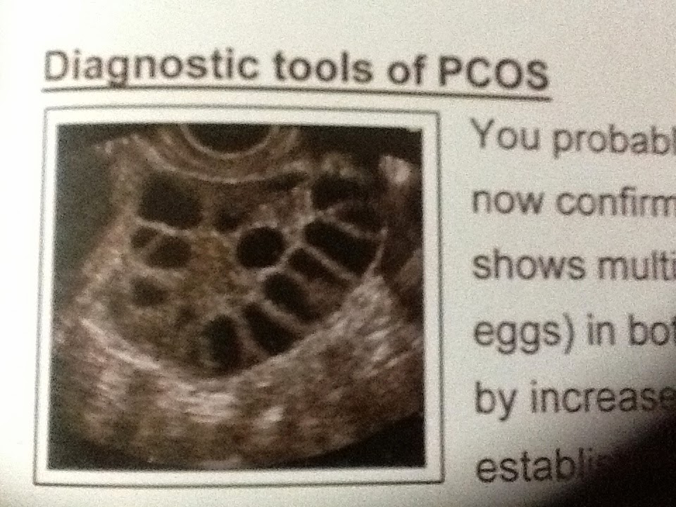 Infertility PCOS (Polycystic ovarian syndrome) is the common reason
