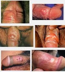 gambar sipilis sipilis pria, sipilis parah, pengobatan sipilis, penyakit sipilis