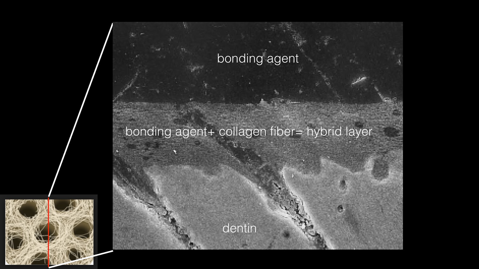 牙e部落客 WET BONDING的前世與今生以及 hybrid layer 之死 台灣牙e通