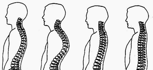 La lesión del lomo nervioso sheynogo del departamento de la columna vertebral