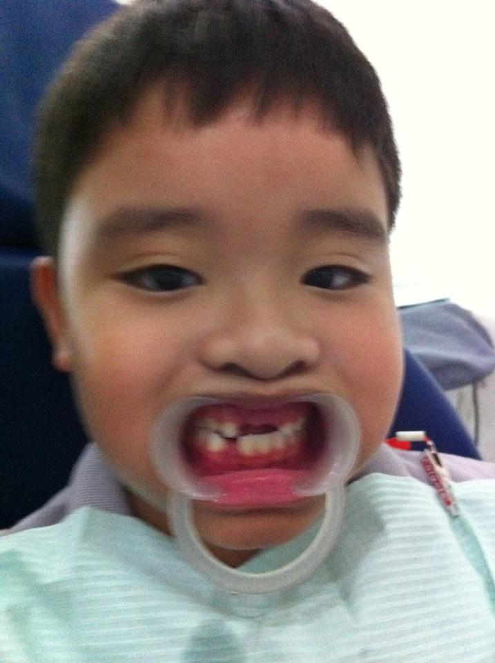 m♥mmil♥ve Space Maintainers with Artificial Teeth