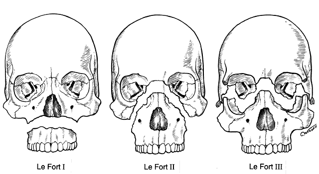 lefort fracture