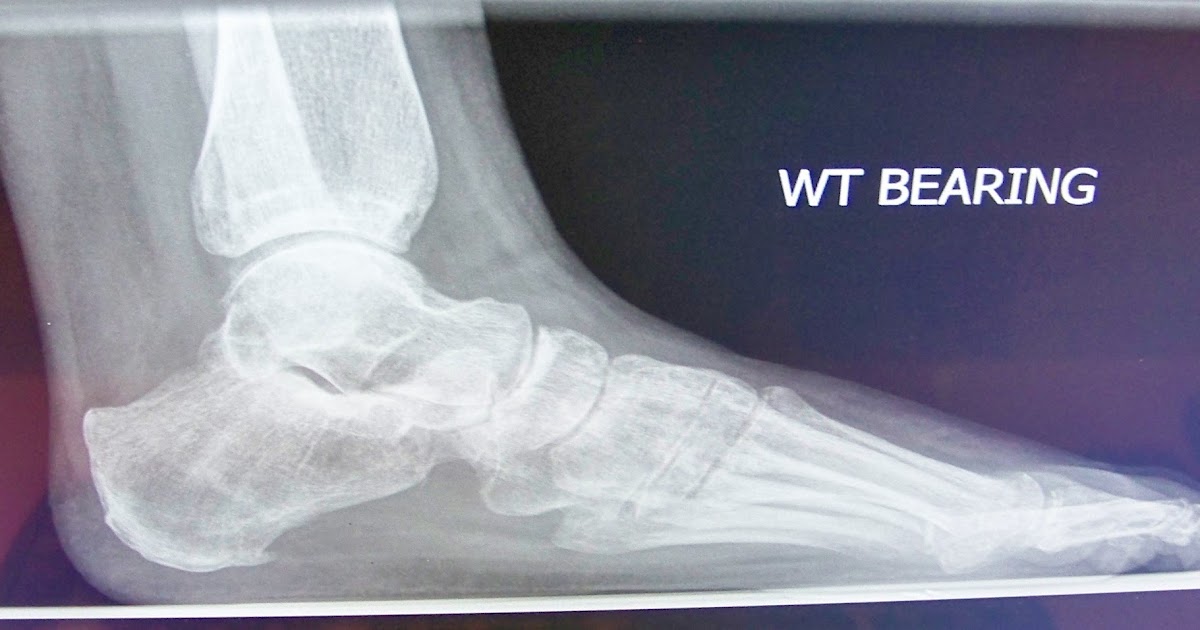 Icd 10 of gestr serrechip