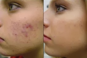 Como fazer peeling de cristal caseiro