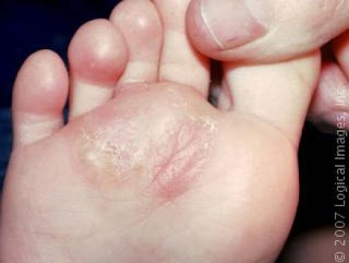 Fungal Feet Infection Fungal Feet Infection