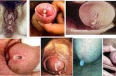 Pengobatan yang Aman Untuk Kencing Nanah Pengobatan yang Aman Untuk Kencing Nanah