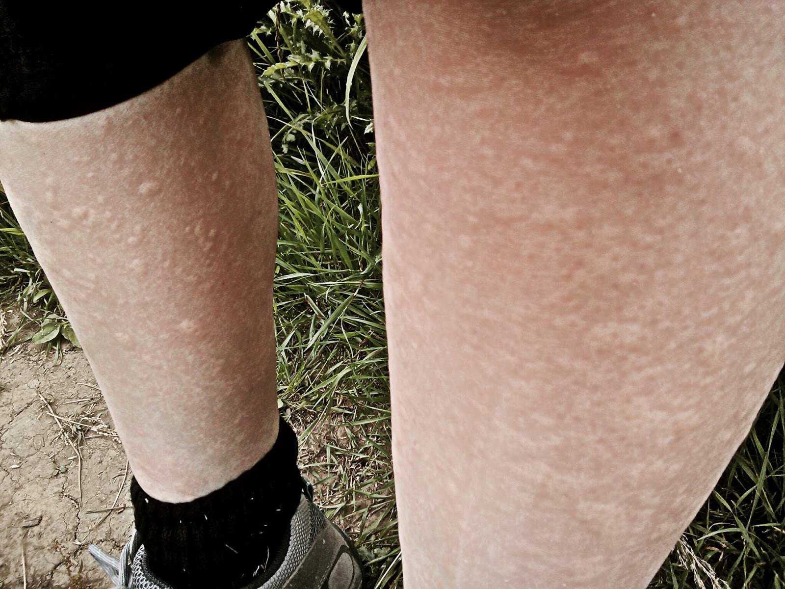tiny balls that itch on feet tiny balls that itch on feet