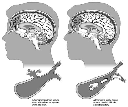 Stroke+ct+scan+images