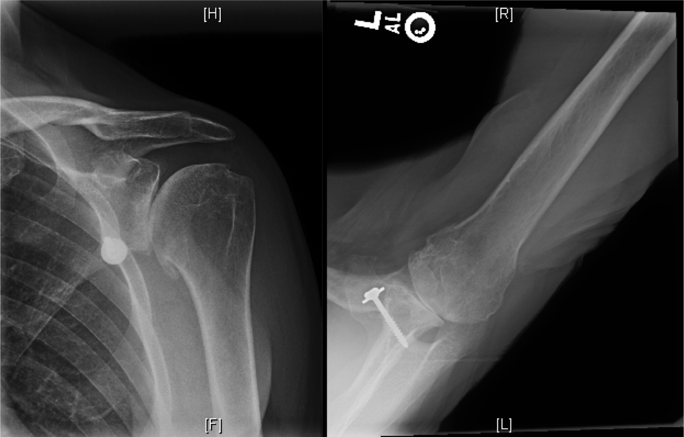 Shoulder Arthritis / Rotator Cuff Tears causes of shoulder pain Ream