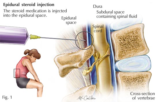 can steroid injections cause harm