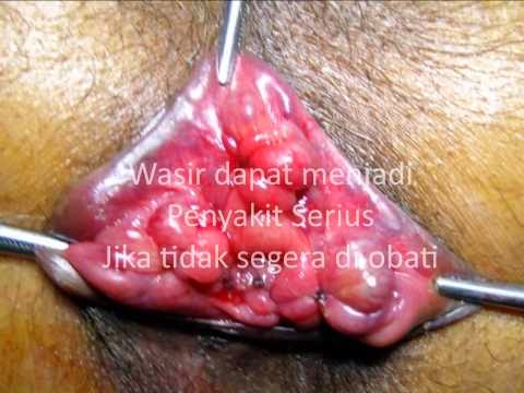 Ambeien Parah Ambeien Parah