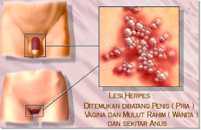 Cara Mengobati Herpes Kelamin Dalam 5 Hari Cara Mengobati Herpes Kelamin Dalam 5 Hari