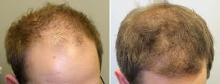 Hair Fall Sulotion For Young Adults Men