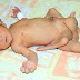 Pakistani baby boy born with six legs