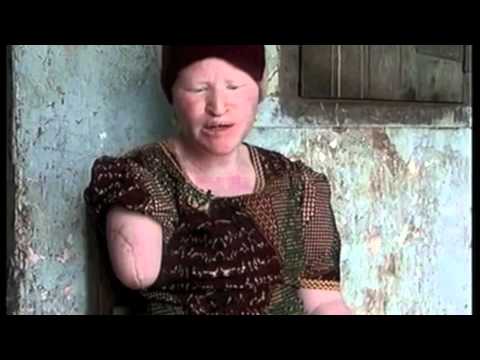 How Albinos are murdered in Africa