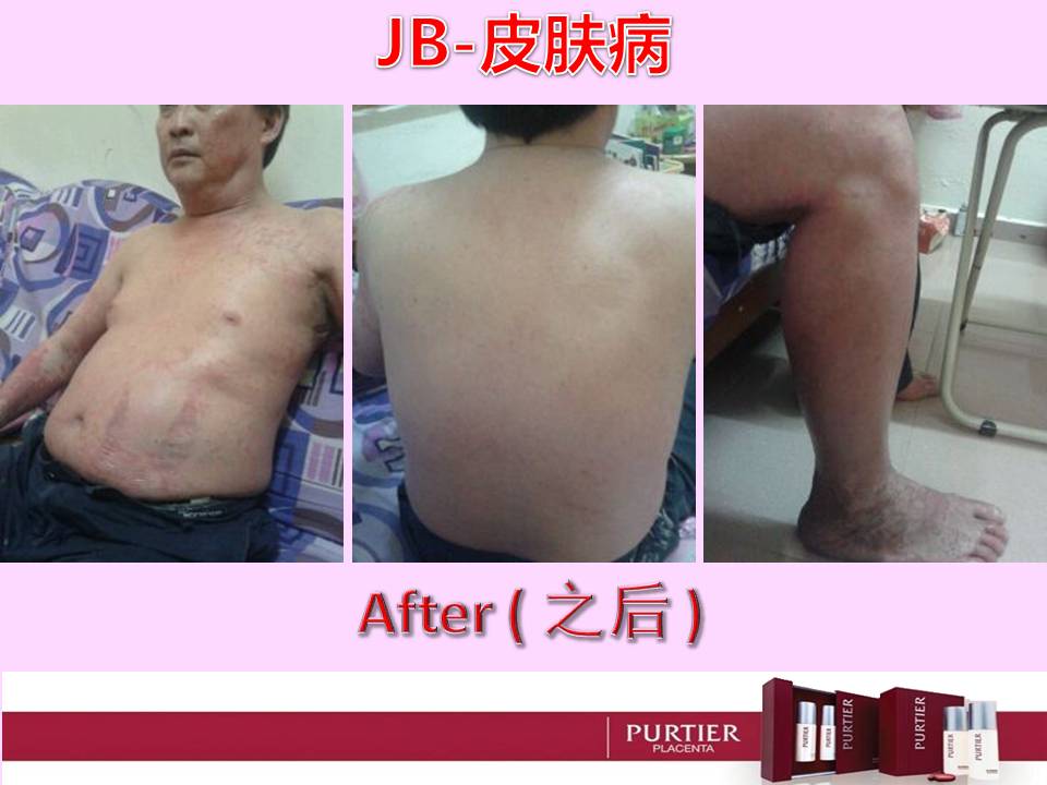 JOHOR BAHRU - SKIN DISEASE (PSORIASIS/ACZEMA/CUTANEOUS CONDITION)