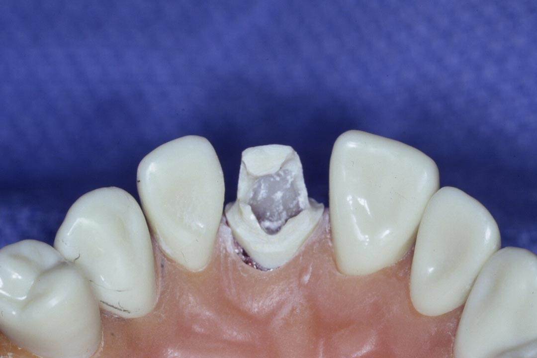 Dentistry Custom Cast Dowel Core