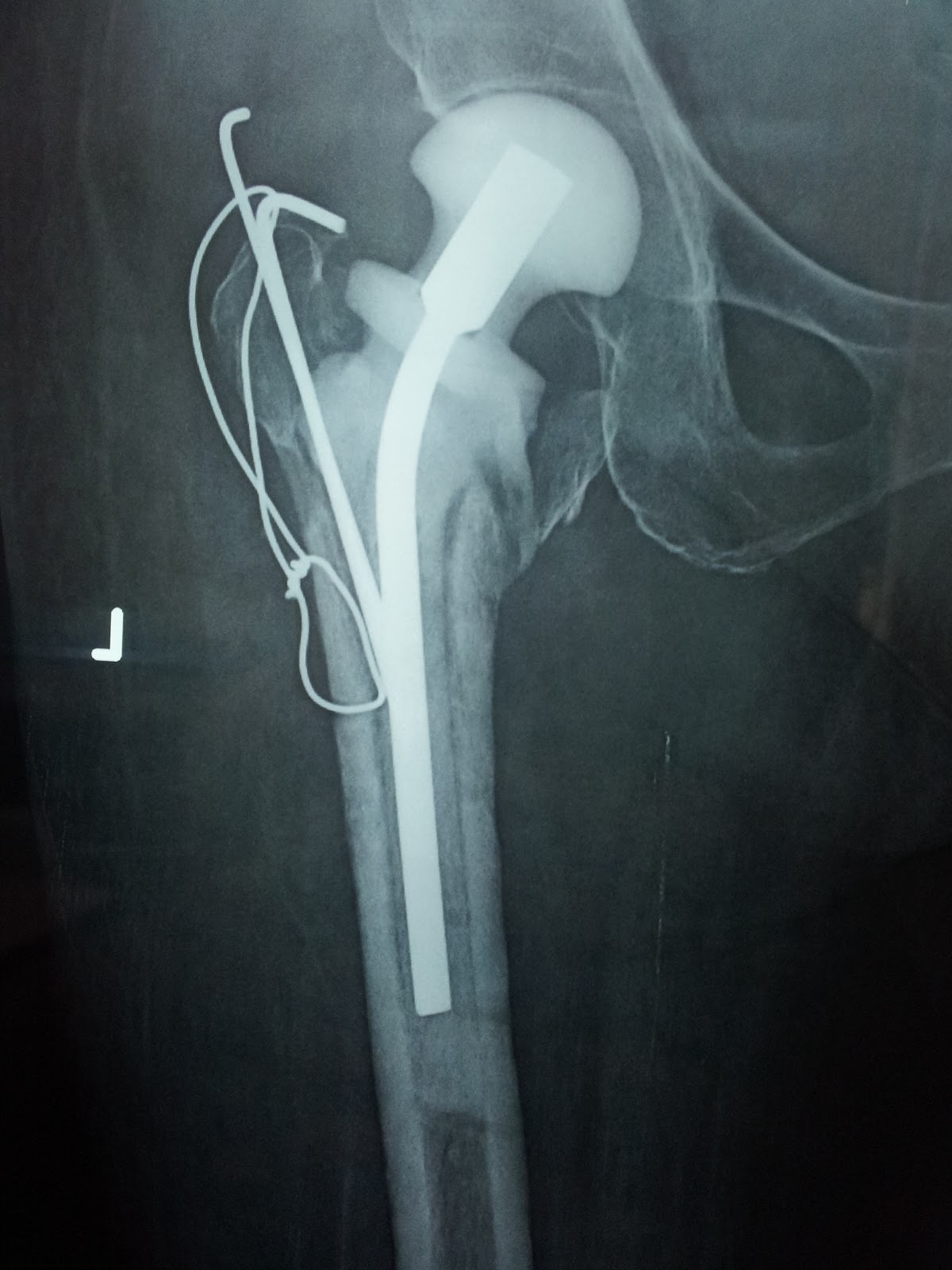 When was the first hip replacement picture