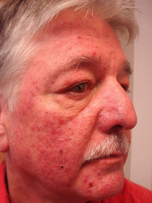 iatrogenic cushing s syndrome secondary to Cushing syndrome, first described by harvey in 1912, refers to signs and which likely is due to interruption of luteinizing hormone-releasing. iatrogenic cushing s syndrome secondary to Cushing syndrome, first described by harvey in 1912, refers to signs and which likely is due to interruption of luteinizing hormone-releasing.