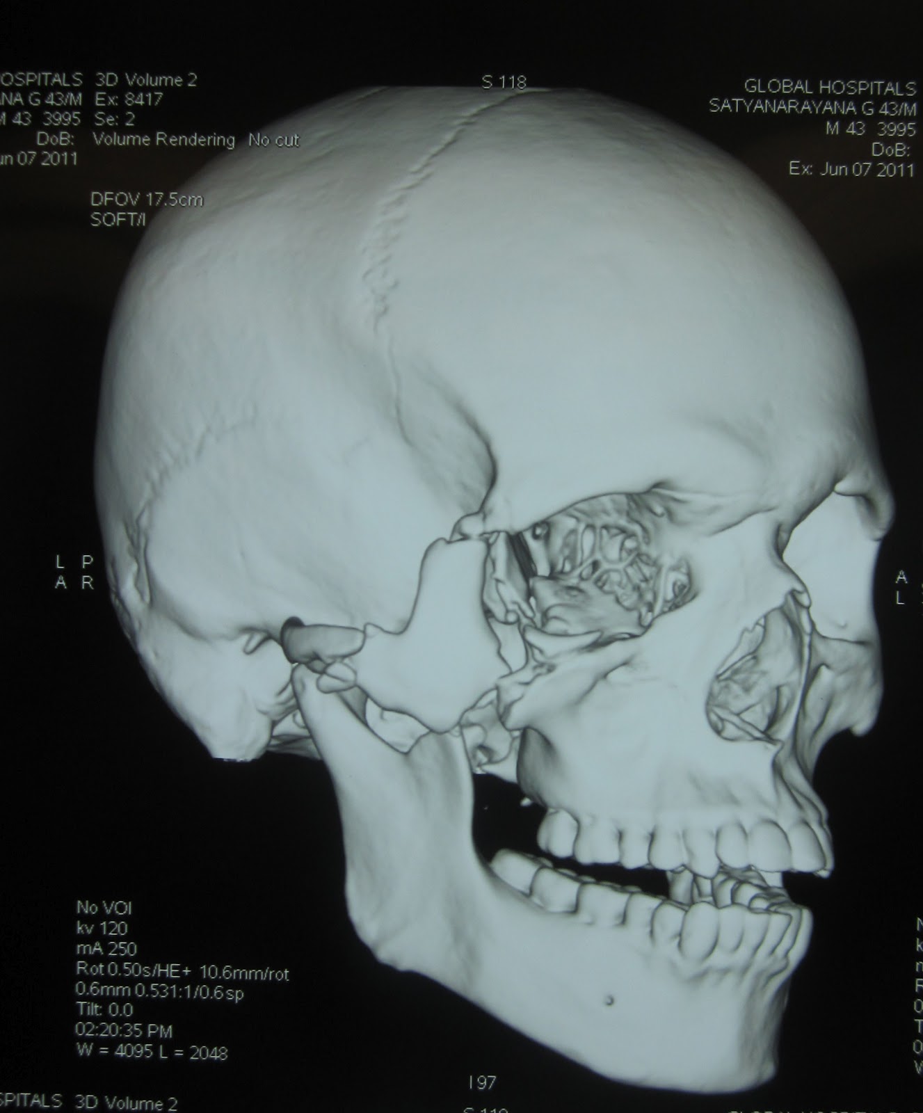 COMMUNITED DISPLACED FRACTURE ZYGOMA FACIO MAXILLARY