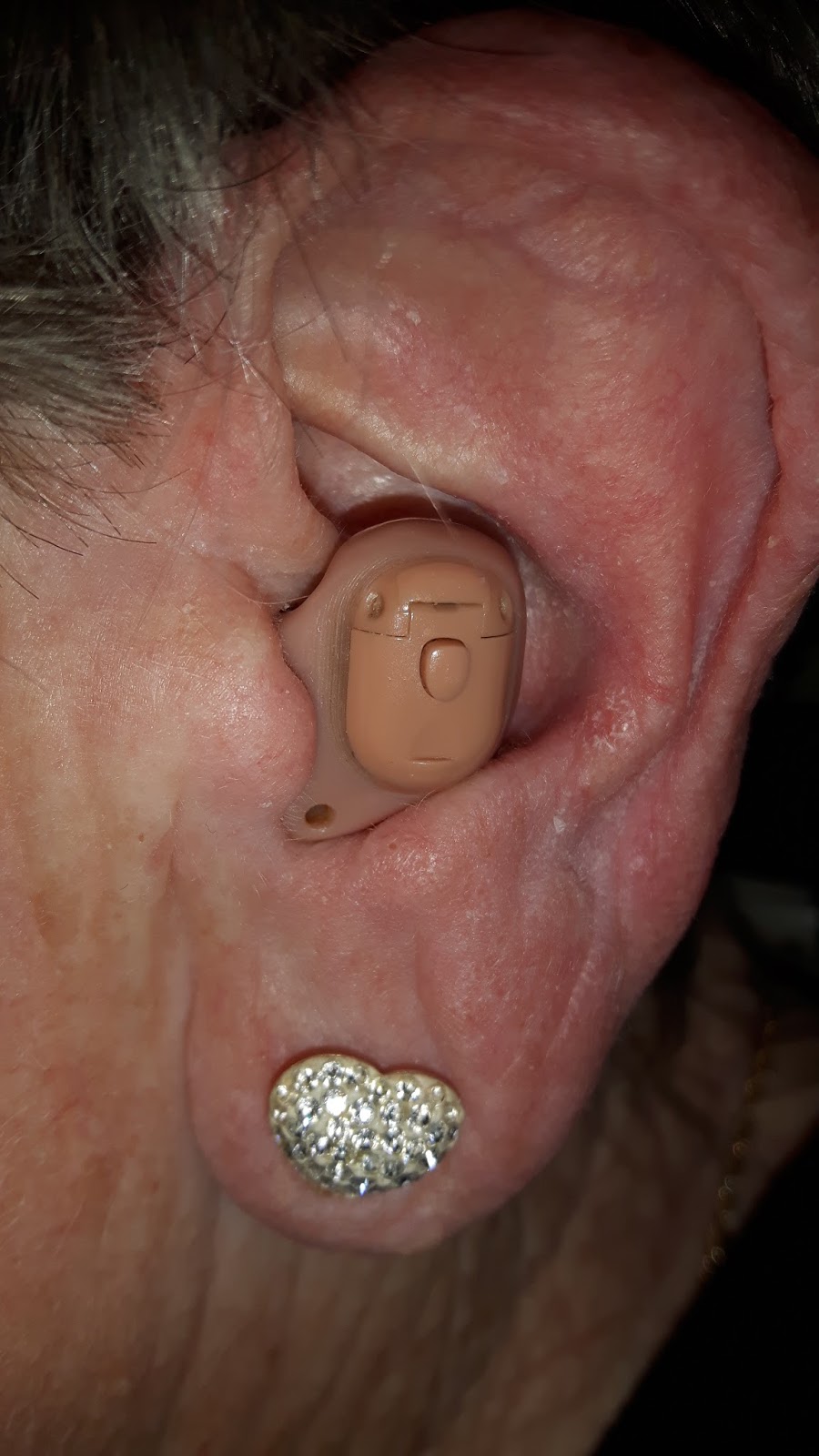 Intheear hearing aids fitting difficulties can cause loss of clarity