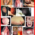 Obat ANTIBIOTIK Gonore yang Bagus thumbnail