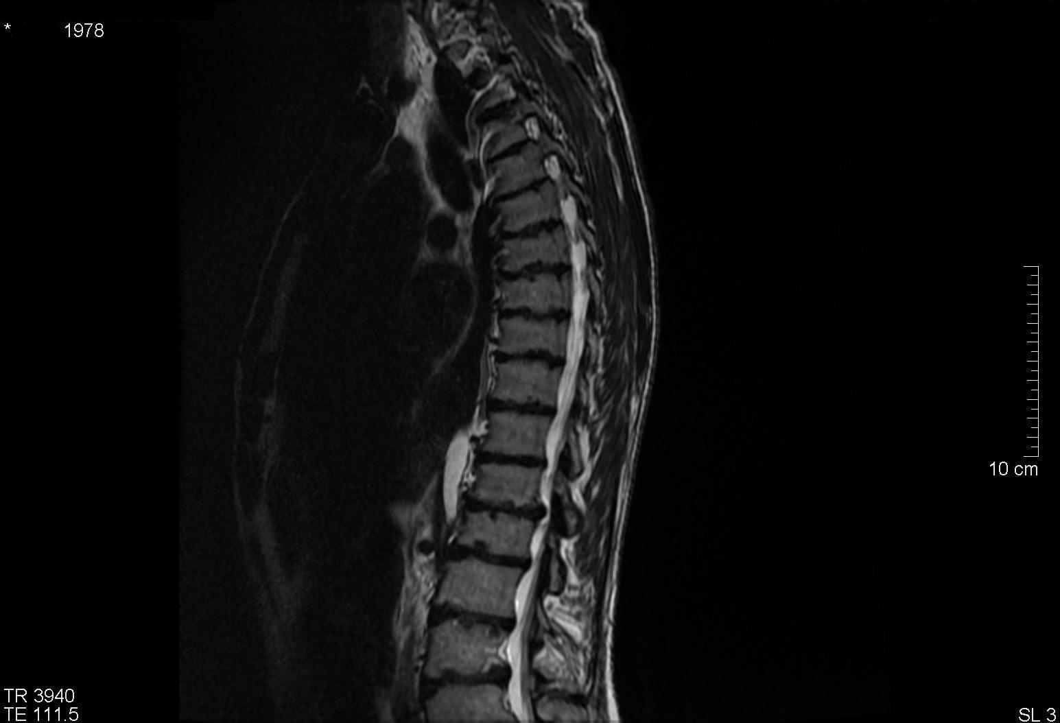 Osteochondrosis of the cervical spine Osteochondrosis of the cervical spine