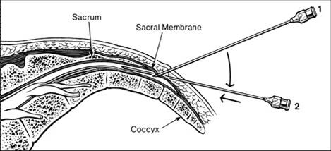 Epidural steroid injection studies