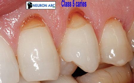 Classification of Dental Caries image19 Classification of Dental Caries