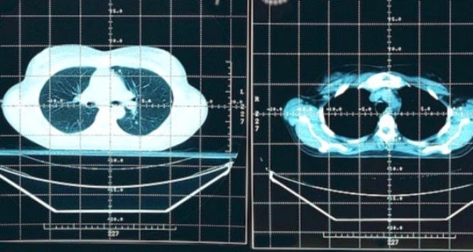 SOS γιατρών για τον καρκίνο του ήπατος SOS γιατρών για τον καρκίνο του ήπατος