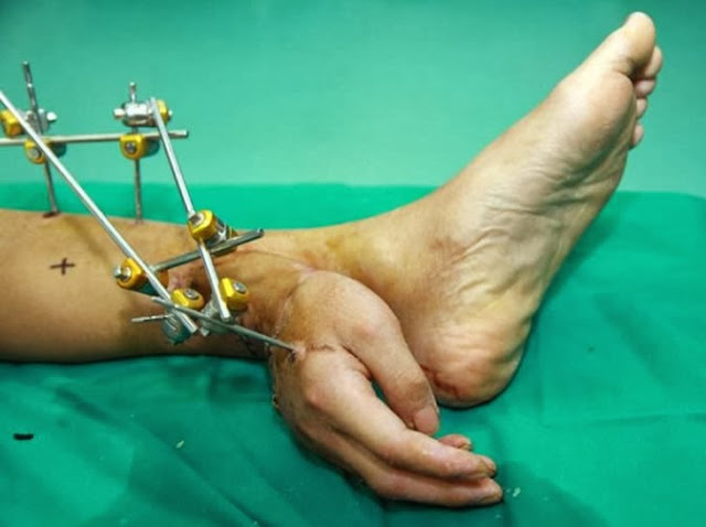Severed Hand Saved After Being Attached To Man’s Ankle