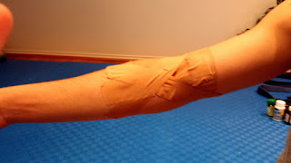 humerus supracondylar