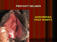 Gejala Dan Obat Kencing Nanah